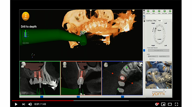 Yomi Robotic Surgery: Boston University Periodontology