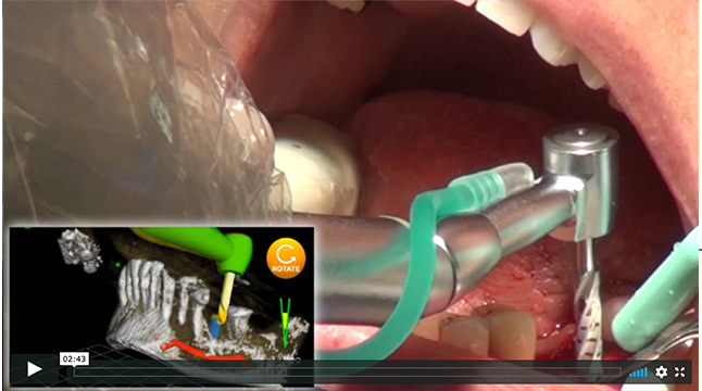 FDA Study Surgeon Interviews and Narrated Surgical Video Highlights